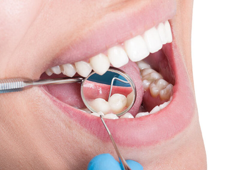 Pre dental hygiene